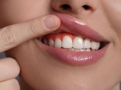 gum contouring
