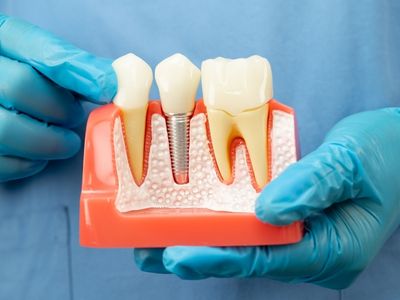 dental implants